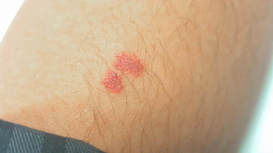 ماذا تدل البقع الحمراء على الساقيين؟