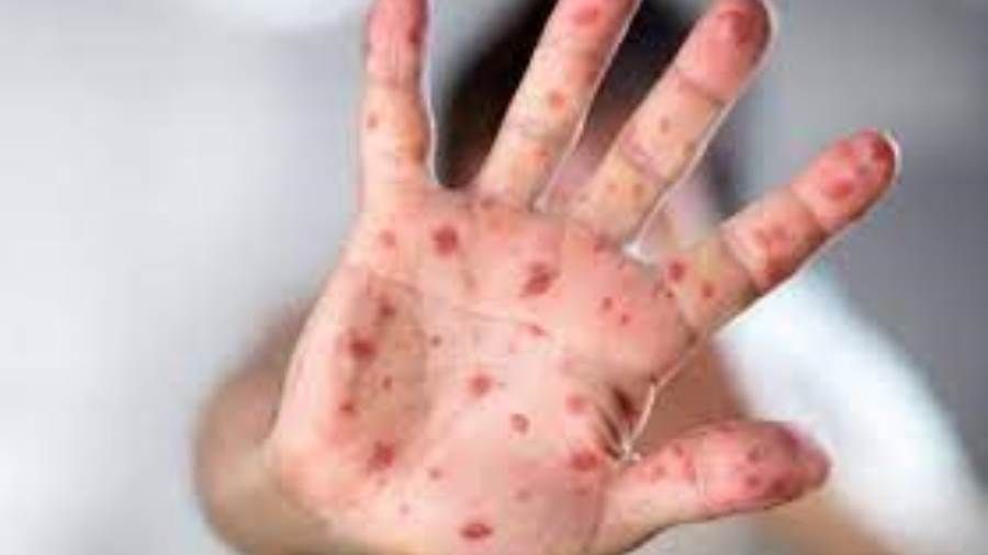 نيجيريا تسجل 31 إصابة بجدري القردة.. منذ بداية العام