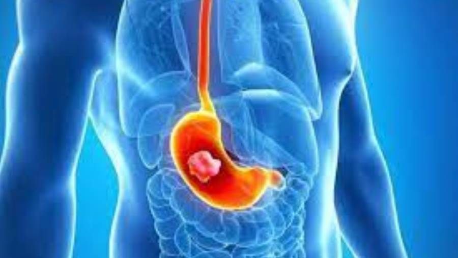 طبيبة روسية تكشف أولى الأعراض المبكرة لسرطان الأمعاء.. ماذا قالت؟