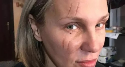 ظهور مفزع لشيرين رضا ووجهها مليء بالكدمات والحروق.. ماذا حدث لوجهها الجميل؟! تشوهه مرعب ومخيف والمفاجأة من الفاعل..صورة