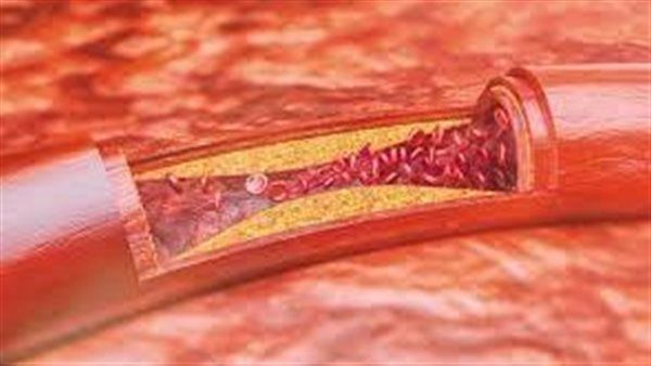 أطعمة يمكن أن "تذيب بشكل طبيعي" جلطات الدم المميتة.. تعرف عليها!