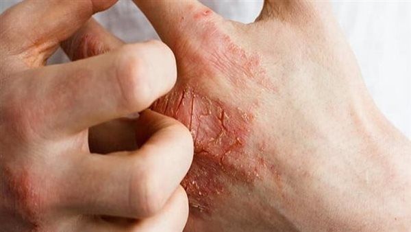 خبراء يزعمون وجود "جانب إيجابي هام" للإكزيما.. ماذا قالوا؟