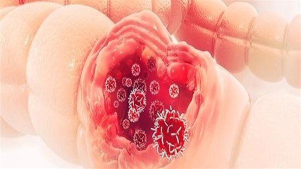 عوامل تزيد من خطر الإصابة بسرطان القولون والمستقيم