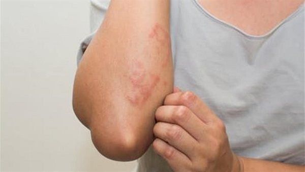 باحثون: آفات جلدية تشير ملاحظتها إلى "المراحل المبكرة من الخرف"