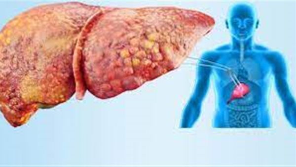 رائحتان تنبعثان من "التنفس" أو "البول" يمكن أن تدلا على مرض الكبد الدهني.. ما القصة؟