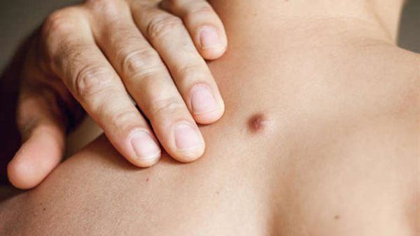 الورم الشحمي على الظهر