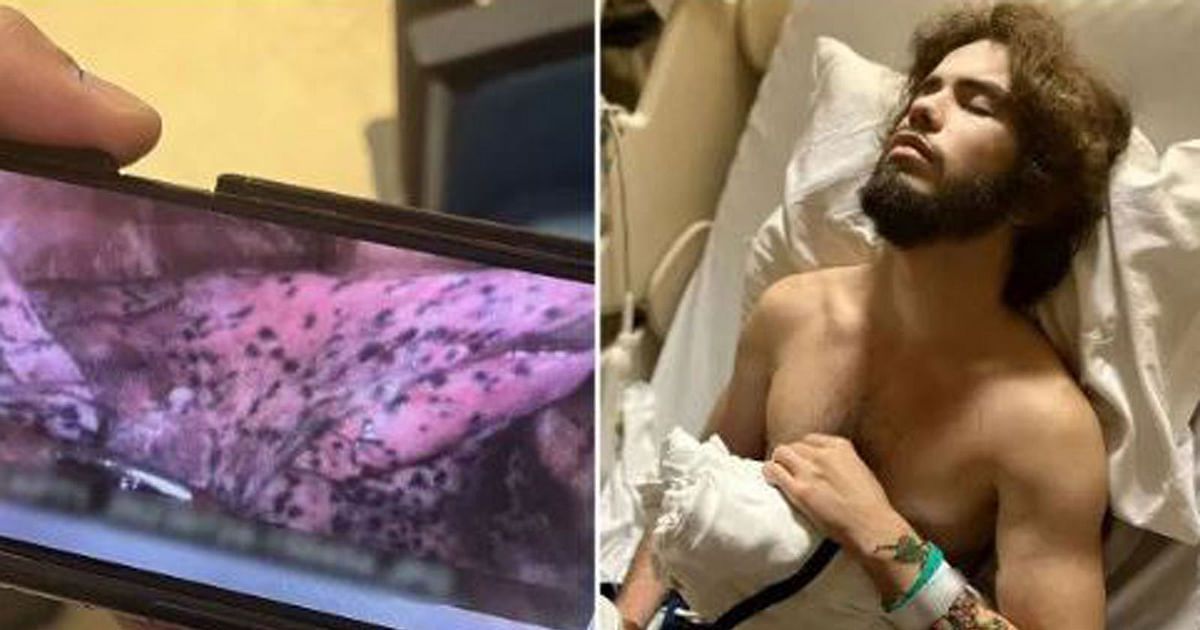 السجائر الإلكترونية تقتل حلم شاب بأن يصبح مقاتلا