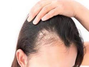 "أقوى وصفة سحرية لملء فراغات فروة الرأس وتكثيف الشعر بسرعة فائقة"