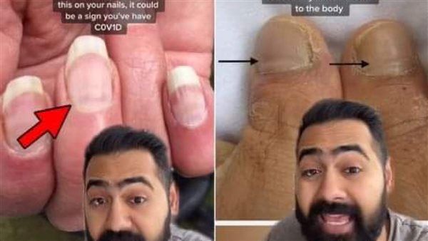 علامة في الأظافر تدل على إصابتك بالمرض الذي حير العالم وقتل الملايين وعجز الأطباء عن علاجه (اتفرج)
