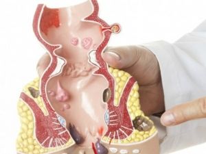 وداعًا للبواسير .. وصفة منزلية سهلة تنهي آلامك بدون تدخل جراحي