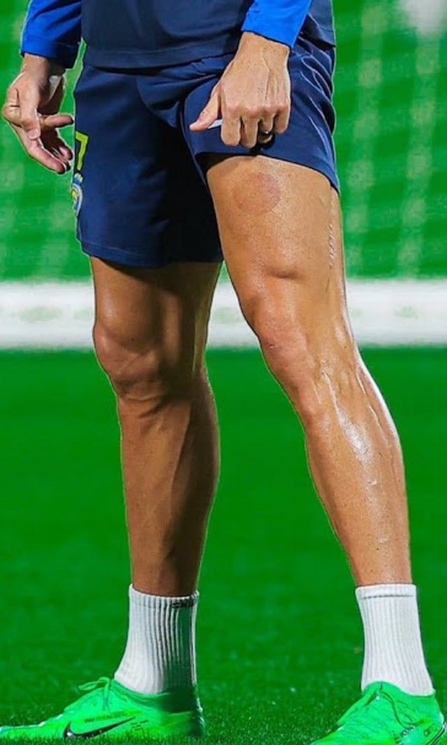 آثار الحجامة تظهر على ساق رونالدو (صورة)