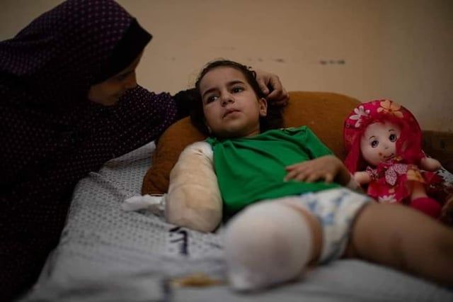 أثناء لعبة الحجلة.. الطفلة حلا تروي مأساة فقدان أطرافها في قصف إسرائيلي (صورة)