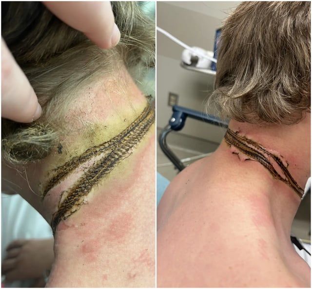 كادت تودي بحياته.. قلادة تتسبب بحروق صادمة لصاحبها (صور)