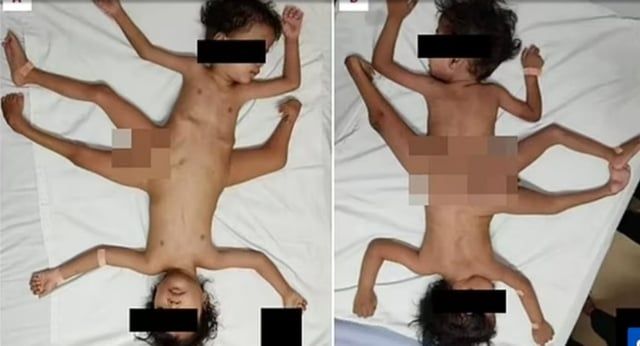 حالة نادرة.. "توأم عنكبوتي" من إندونيسيا يجلسان لأول مرة