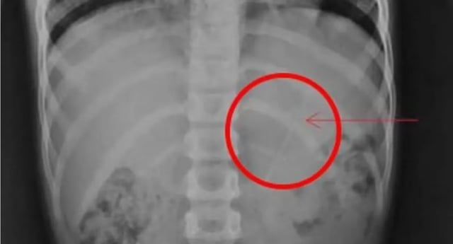 طفل ينجو بأعجوبة بعد ابتلاعه "جسما غريبا" (صورة)