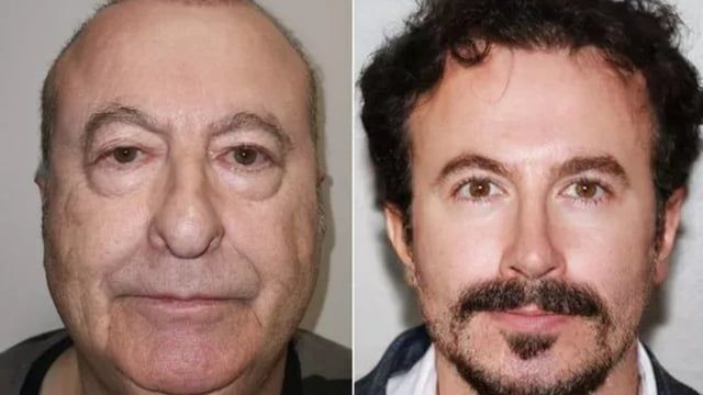 جراحات تجميل صادمة في تركيا.. والمرضى أصغر بـ30 عامًا (صور)