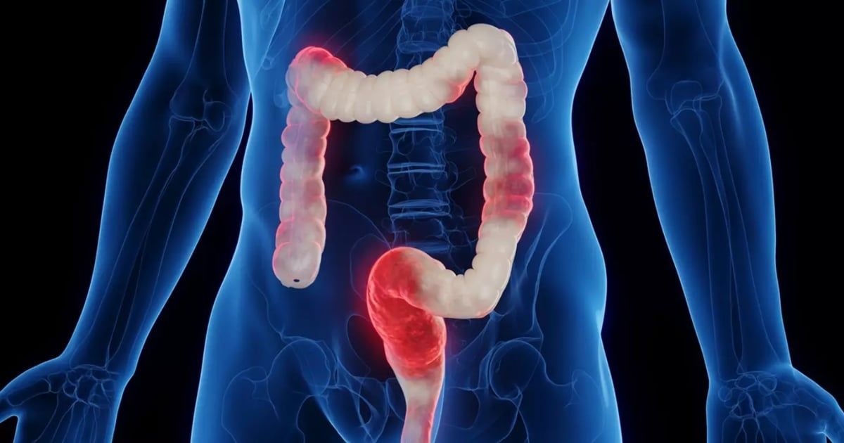 اكتشاف طبي "مهم" يمنح الأمل للمصابين بداء "الأمعاء الالتهابي"