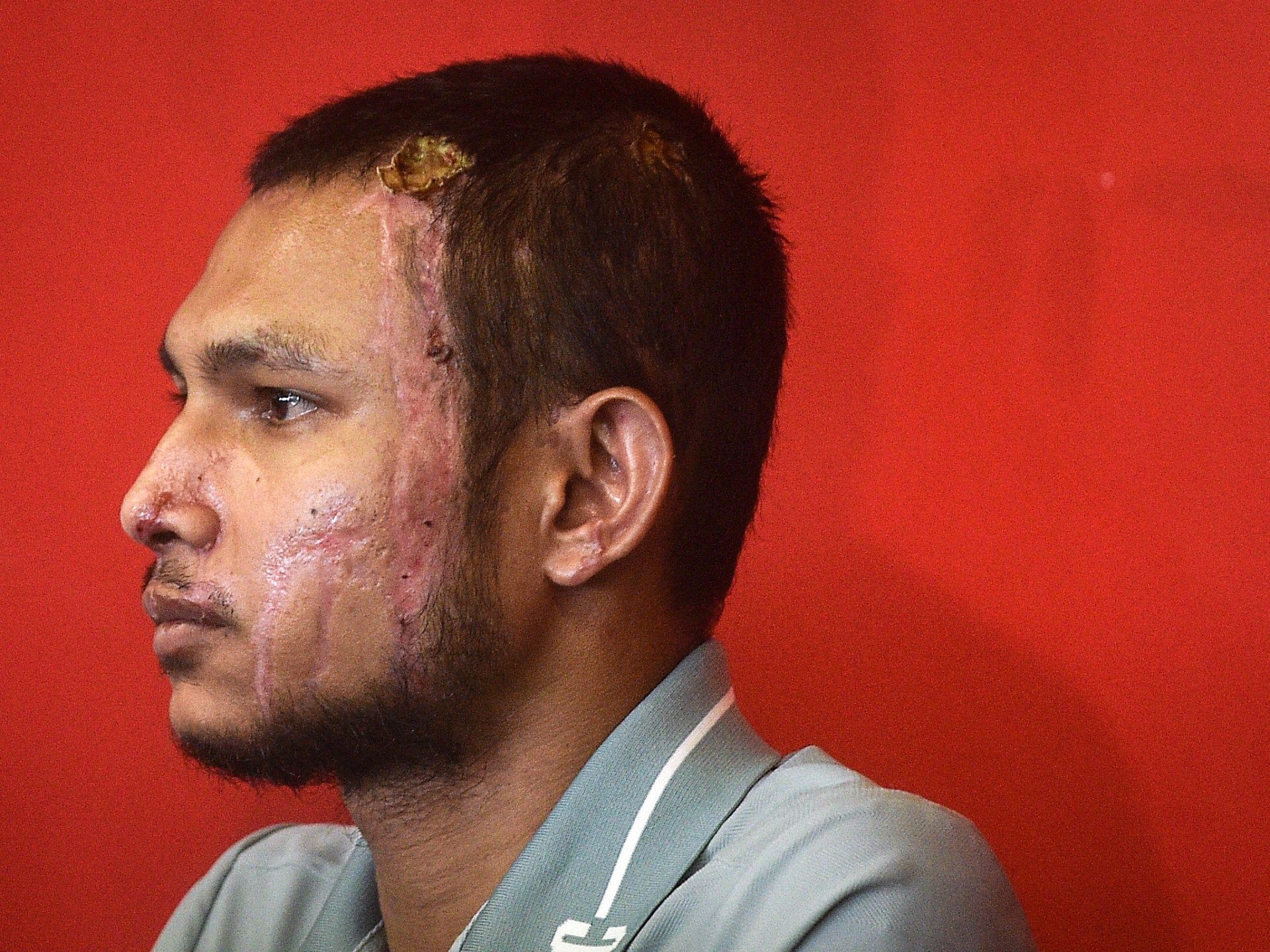 أول ظهور علني لفيصل حليم لاعب ماليزي تعرض لهجوم كيميائي - موقع الخليج الان