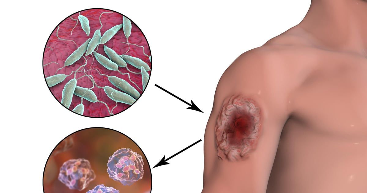 البكتيريا "آكلة اللحم" تنتشر بمعدل قياسي في اليابان