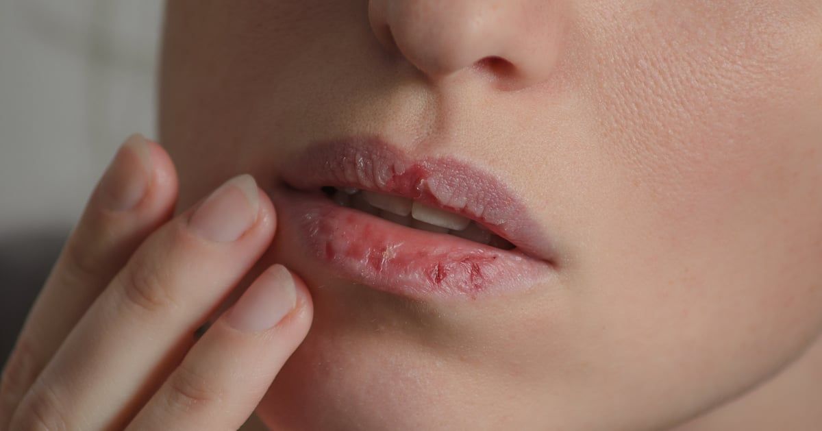 5 أسباب لجفاف وتشقق الشفاه في فصل الصيف