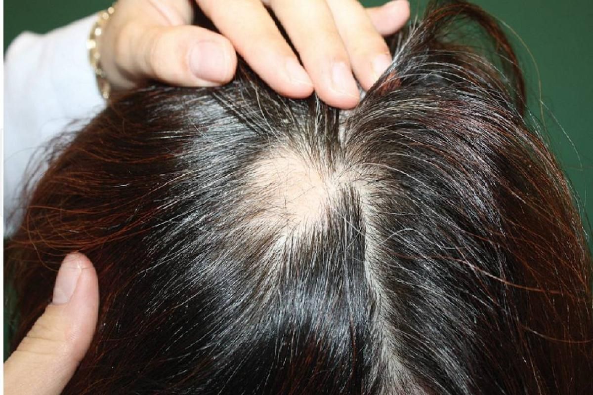 عاجل!! طبيب سعودي يحذر من استخدام الثوم لعلاج مرض الثعلبة - موقع الخليج الان