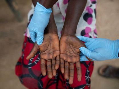 548 وفاة بجدري القرود في الكونغو الديمقراطية منذ مطلع العام