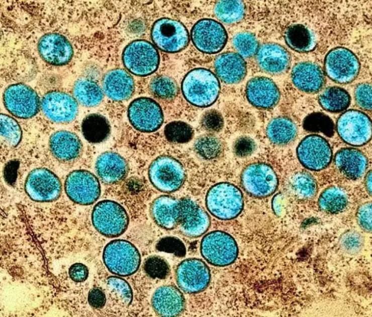 تايلاند تؤكد إصابة شخص بسلالة فرعية من جدري القردة