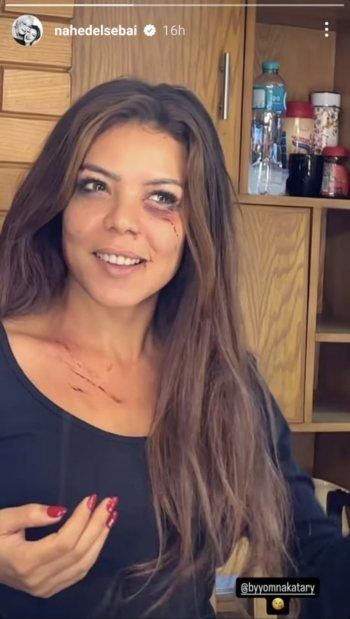 بالصورة: ناهد السباعي تظهر بجروح وكدمات على وجهها.. فما القصة؟