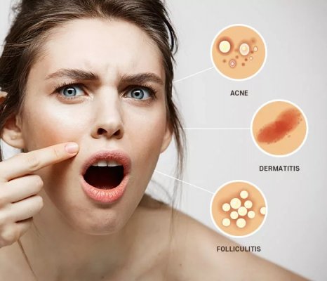 خطوات فعالة في القضاء على جميع مشكلات البشرة وانسي بعد ذلك الذهاب لصالونات التجميل