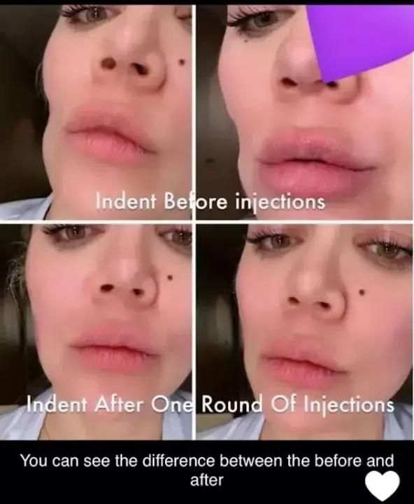 بالصور: “حفرة واضحة”.. شاهدوا كيف أصبح وجه كلوي كارداشيان بعد إصابتها بسرطان الجلد