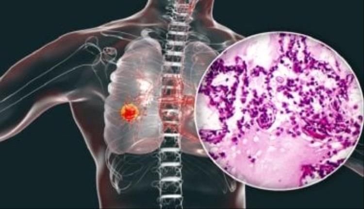 لماذا تزداد الإصابة بسرطان الرئة بين النساء غير المدخنات؟