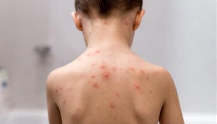 رصد أول إصابة بجدري الماء في هذه المحافظة