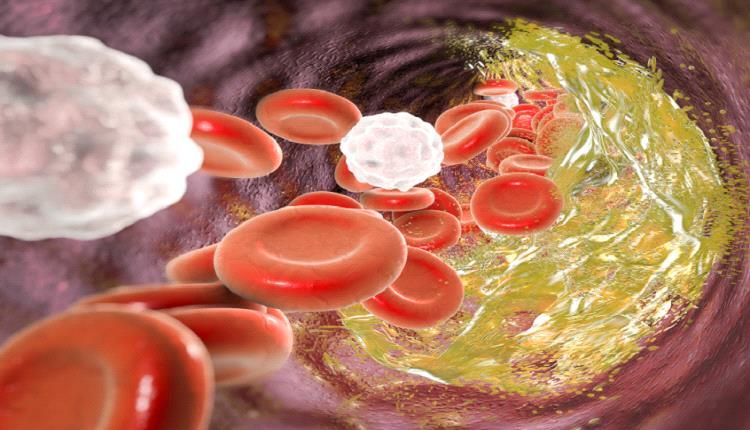 مشروب سحري لخفض كوليسترول الدم !