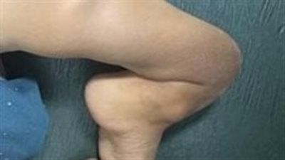 عظمية نادرة.. نجاح عملية نادرة لطفل على يد فريق طبي بجامعة أسيوط بعد سنوات من المعاناة - الخليج الان