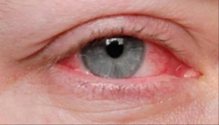 علاجات منزلية آمنة لالتهاب العين