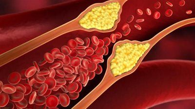 تزايد إصابات ارتفاع الكوليسترول بين الشباب: تحذيرات طبية وتوصيات عاجلة - الخليج الان