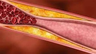 5 أطعمة طبيعية تنظّف الشرايين وتقلل خطر أمراض القلب والسكتات - الخليج الان