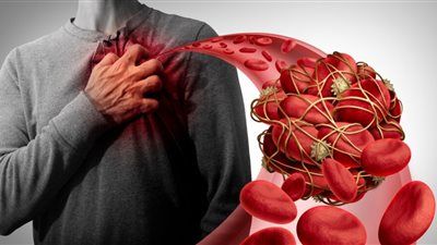 وزارة الصحة: هذه العادات اليومية قد تسبب الجلطات الوريدية دون أن تشعر - الخليج الان