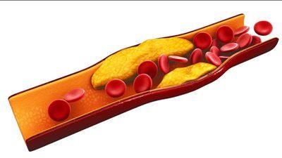 الكوليسترول الطبيعي.. الرقم الذي ينقذ حياتك أو يهددها - الخليج الان