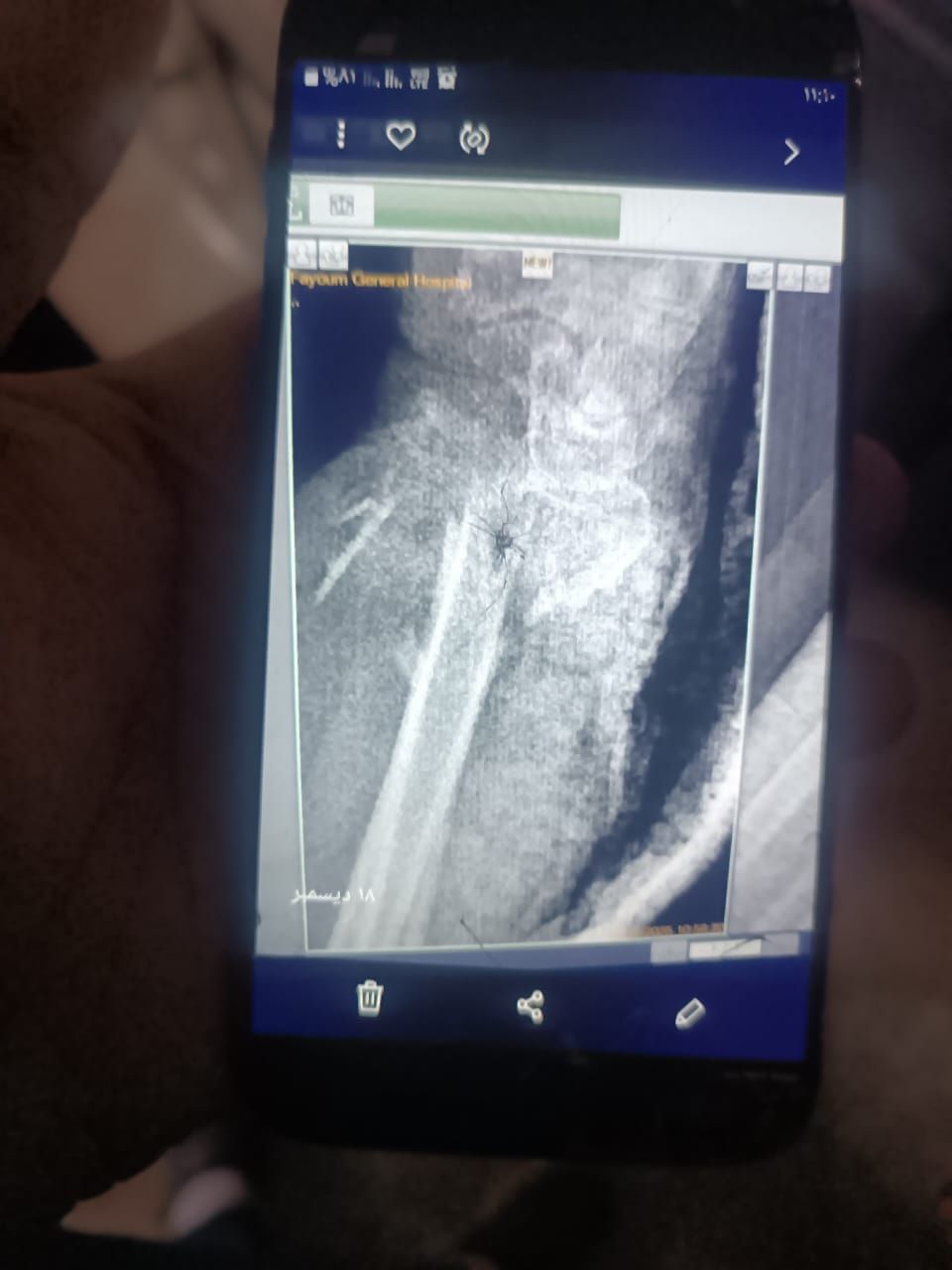 مستشفى الفيوم العام تنقذ حياة سيدة مسنّة بعد سقوط من علو وتجري جراحة ميكروسكوبية دقيقة باليد - الخليج الان