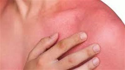 القصة الكاملة لـ استيراد الجلد البشري المجمد بمصر رسميا..تفاصيل وصول أول شحنة - الخليج الان