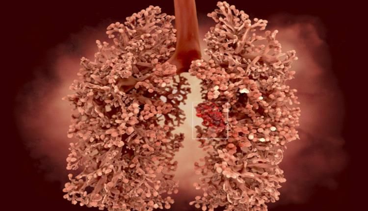 خطورة التعرض للإصابة بسرطان الرئة !