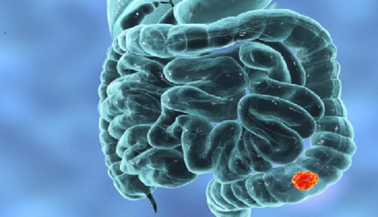 سرطان شائع سببه صادم !