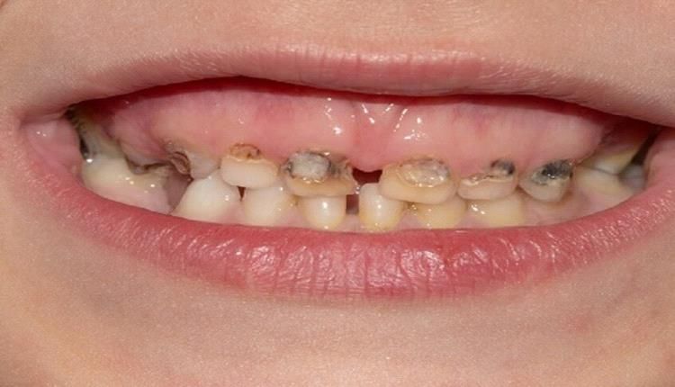تسوس أسنان الأطفال...سبب لا تتوقعه !