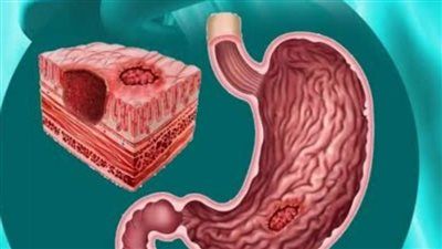 "وجع صامت يبدأ بحرقة خفيفة " قرحة المعدة وخطورتها وكيف يتم التعامل معها؟ - الخليج الان