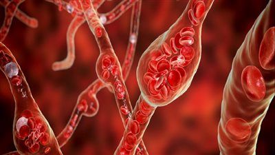 تحذيرات علمية دولية.. عامل بيئي خفي وراء ارتفاع ضغط الدم - الخليج الان