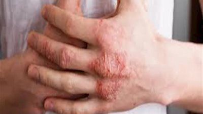 تعرف على أهم فوائد زيت جوز الهند لعلاج الإكزيما وطرق استخدامه الصحيحة - الخليج الان