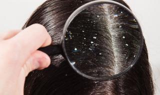قشرة الشعر وطرق علاجها وتجنب ظهورها مرة اخري