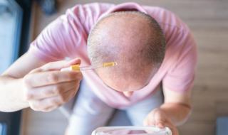 عقار يعالج تساقط الشعر يؤثر على خصوبة الرجال
