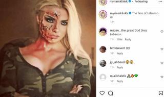 بالصورة: أطلت بوجه مشوّه.. هذا ما حصل مع ميريام كلينك